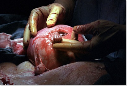 La main du foetus